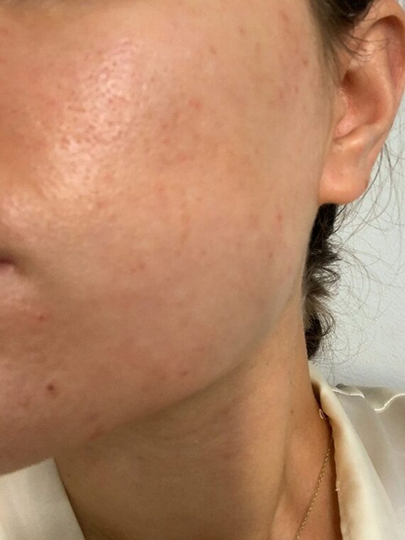 revolution skin care sérum proti pigmentovým skvrnám zkušenosti test před a po